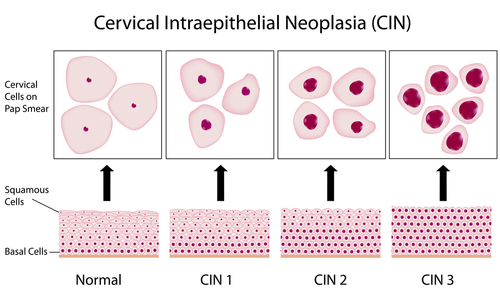 Treatment For Cervical Cancer Total Health   CIN Stages 